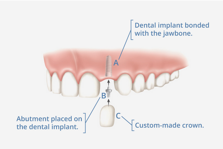 Dental Implants In Katy, TX - Olim and Associates